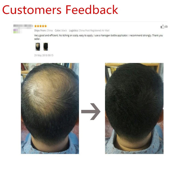 Customer feedback showing dramatic before and after results using Sevich Hair Building Fibers Keratin Thickening Powder for hair loss coverage.
