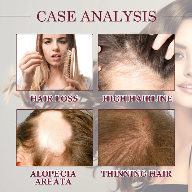 Hair Growth Oil Anti Hair Loss Spray targets hair loss, high hairline, alopecia areata, and thinning hair with visible case analysis examples.
