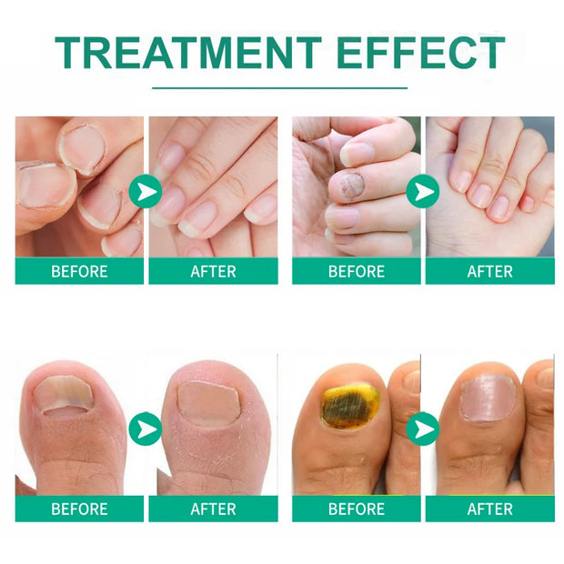 Extra starkes Reparaturserum zur Behandlung von Nagelpilz