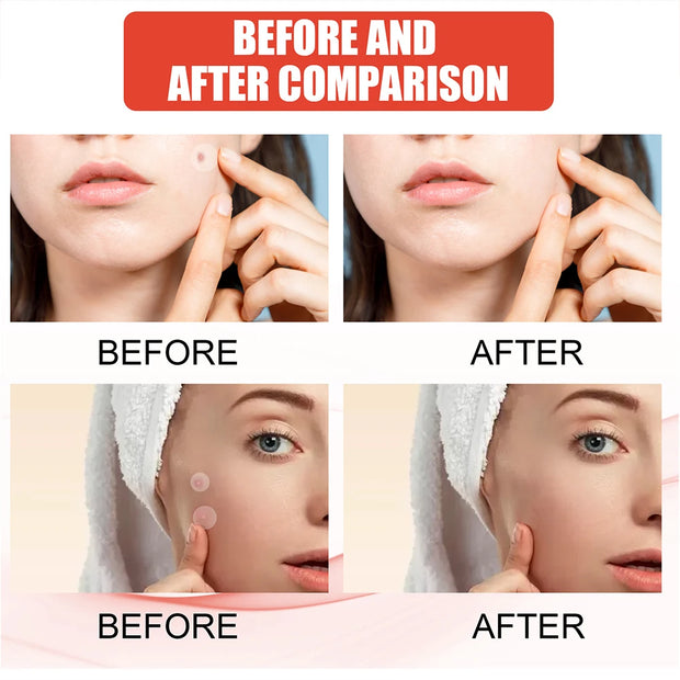 Acne Pimple Patches Invisible Spot Treatment